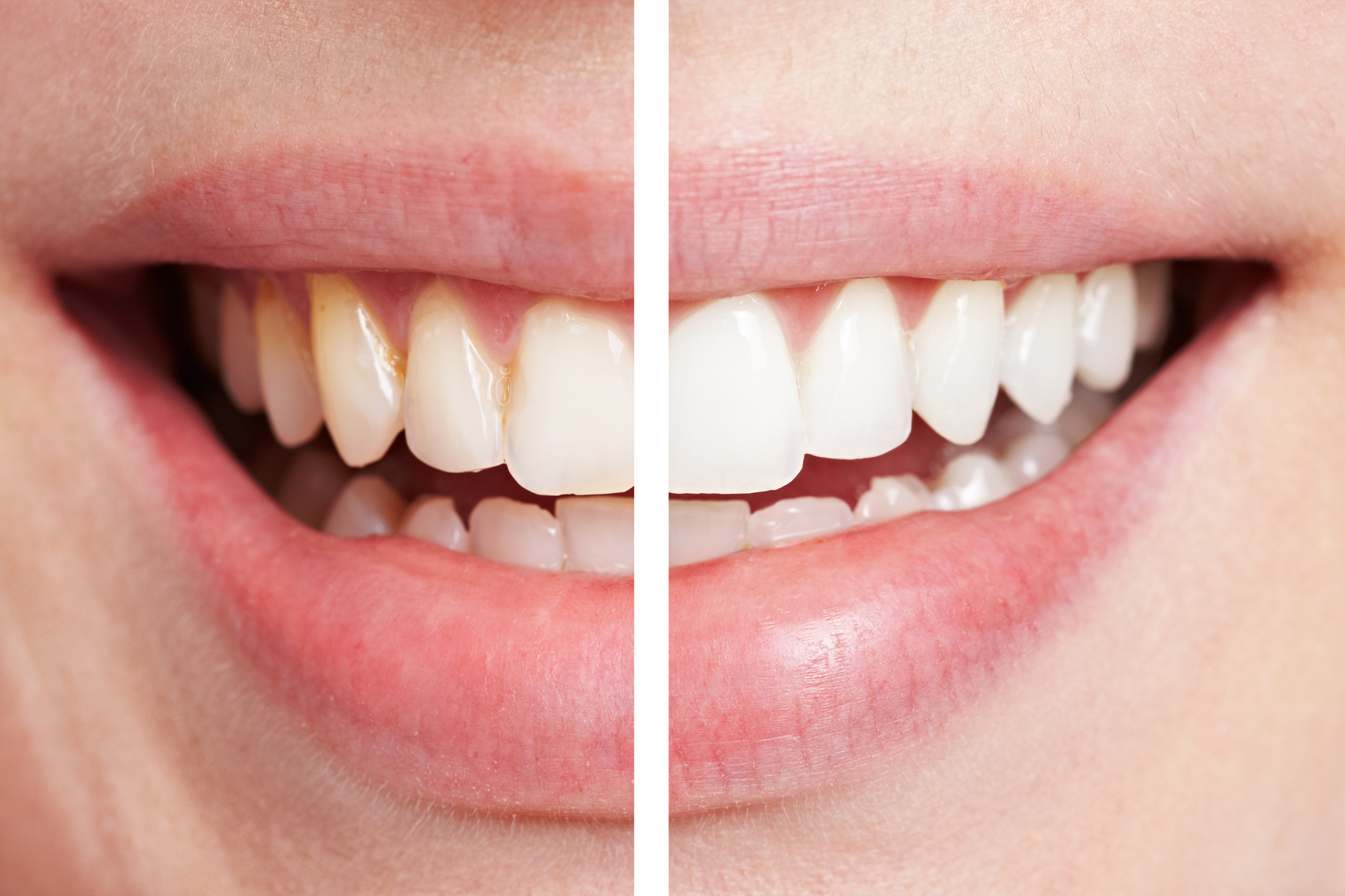 Vergleich von Zähnen vor und nach dem Bleichen beim Zahnarzt