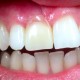 Zahnimplantate und Zahnersatz aus einer Hand in unserer Praxis in Leipzig 6