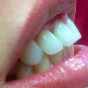 Zahnimplantate und Zahnersatz aus einer Hand in unserer Praxis in Leipzig 7