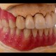 Zahnimplantate und Zahnersatz aus einer Hand in unserer Praxis in Leipzig 4