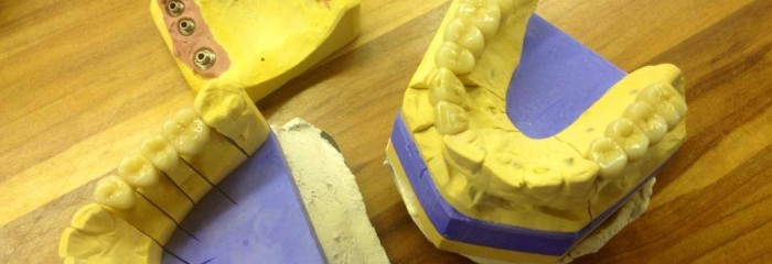 Zahnimplantate und der dazu gehörige Zahnersatz aus unserem Labor, " Alles aus einer Hand "