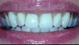 Zahnimplantate machen glücklich 1