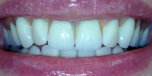 Zahnimplantate machen glücklich 1