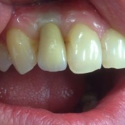 Zahnimplantate machen glücklich 2