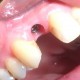 Zahnimplantate machen glücklich 3