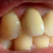Zahnimplantate machen glücklich 4