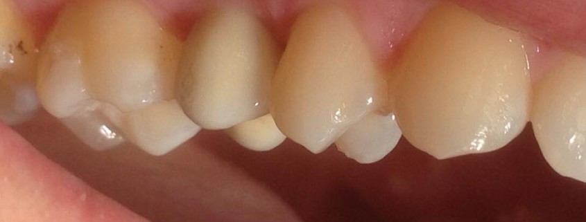 Zahnimplantate machen Glücklich