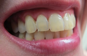 Tipps zur richtigen Zahnpflege 2